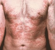 problematic skin is a symptom of the presence of parasites