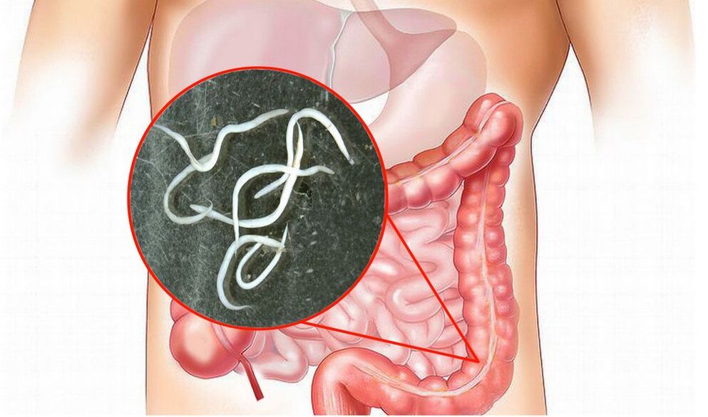 worms in the intestines