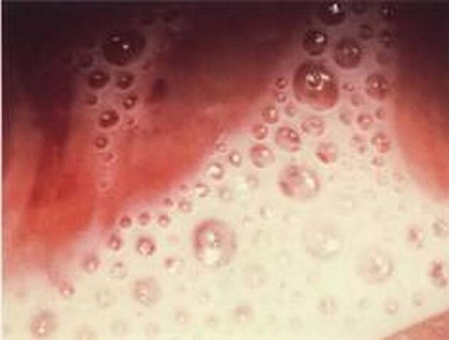 bubble discharge with protozoan parasites