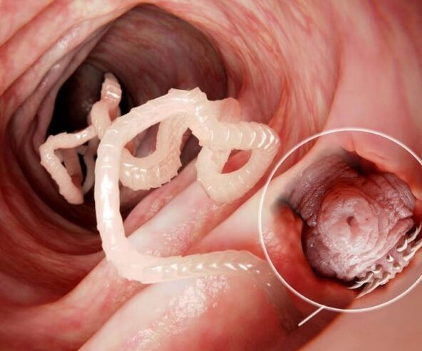 worms in the human intestine photo 2