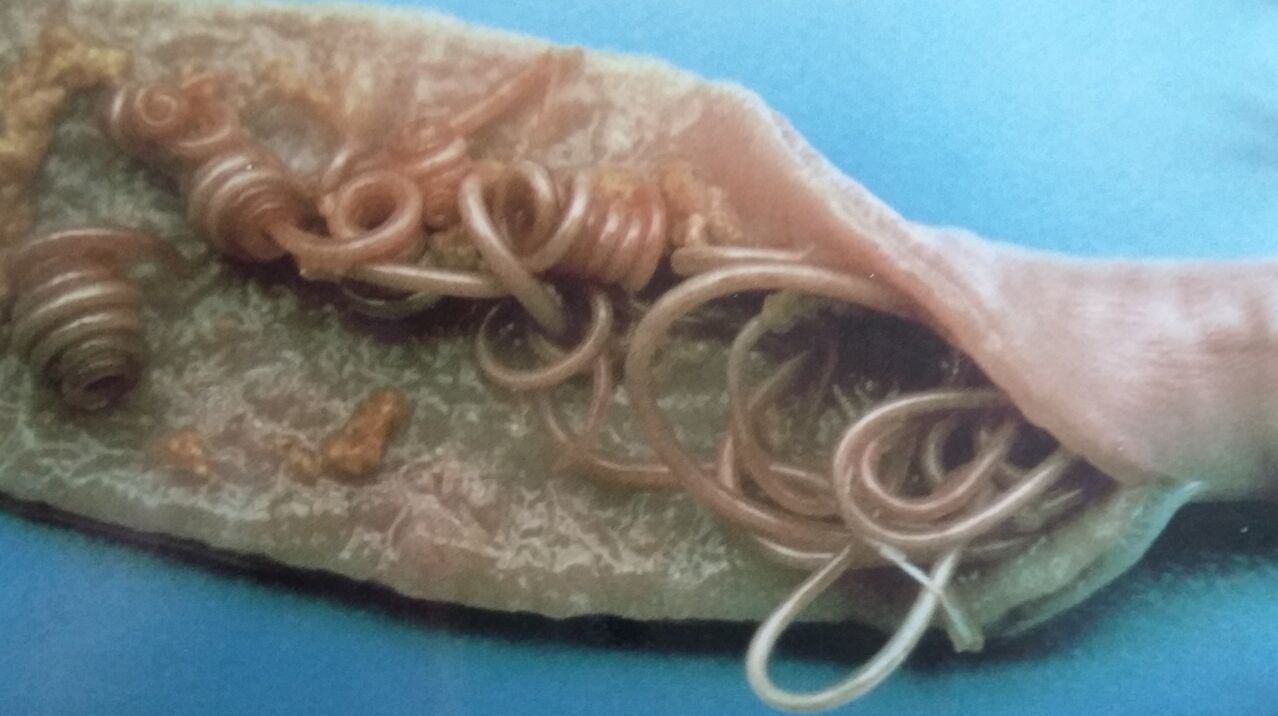 roundworm worms from the human body